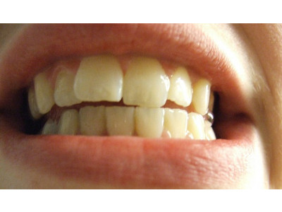 Philips Sonicare FlexCare Premium Toothbrush 2 Pack Was $180 | Now $145 & Free Shipping @ Costco Canada